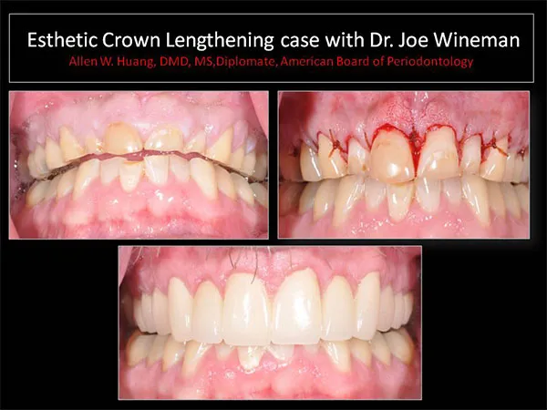 Esthetic crown lengthening case study - Las Vegas, NV