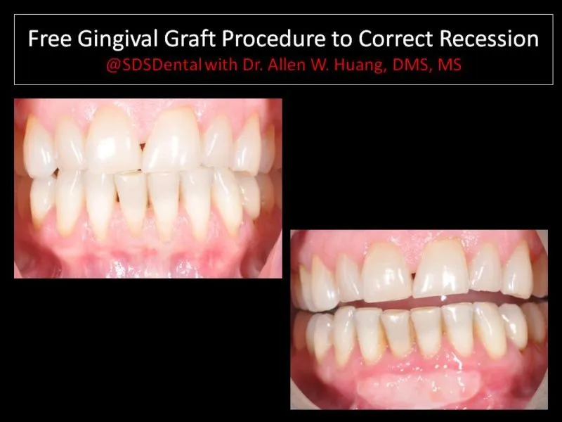 Free gingival graft lower anterior - Las Vegas, NV