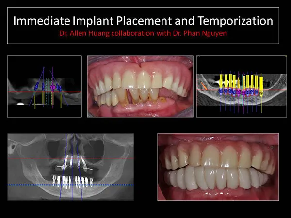 full mouth reconstruction - Las Vegas, NV