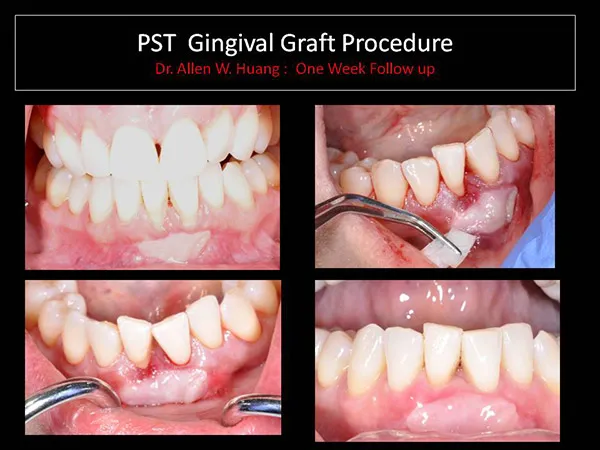 gingival graft - Las Vegas, NV