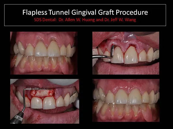 gum graft - Las Vegas, NV