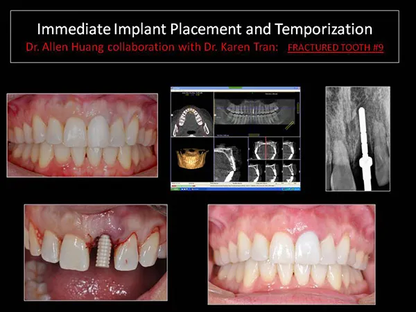 one day implant - Las Vegas, NV