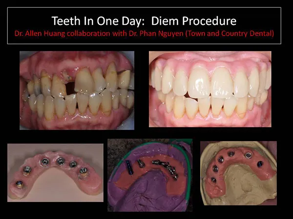 one day teeth reconstruction - Las Vegas, NV
