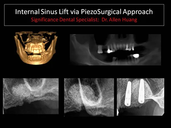 piezosurgical approach - Las Vegas, NV