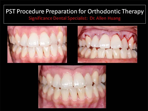 PST orthodintic procedure - Las Vegas, NV