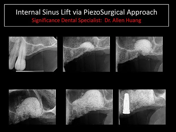 sinus lift - Las Vegas, NV