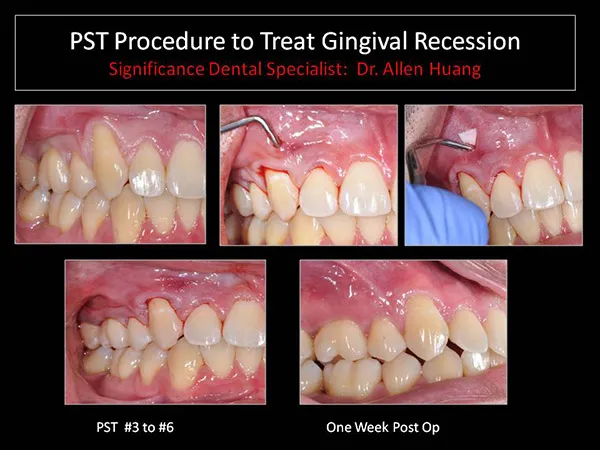 treating gum recession - Las Vegas, NV