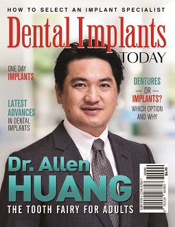Dental Implants Today - Dr. Allen Huang