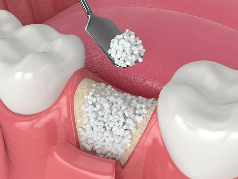 Bone Grafting and Implant Preparation