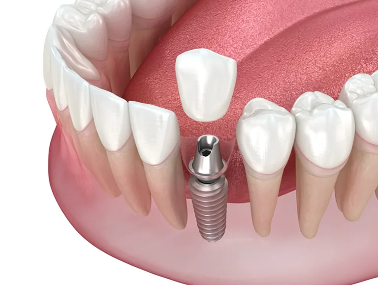 A single missing tooth is a bigger problem than most patients realize