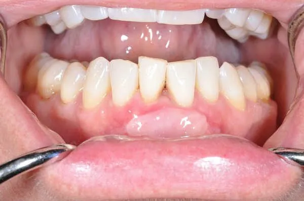 after gum graft - Las Vegas, NV