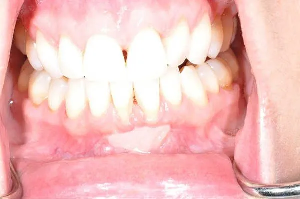 before gum graft - Las Vegas, NV