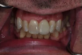 after anterior implant - Las Vegas, NV