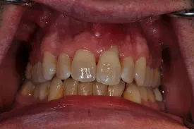 before anterior implant - Las Vegas, NV