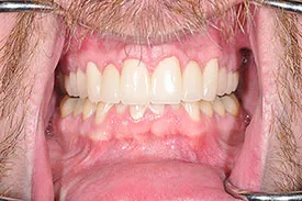 after crown lengthening - Las Vegas, NV
