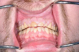before crown lengthening - Las Vegas, NV