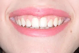 after crown lengthening - Las Vegas, NV