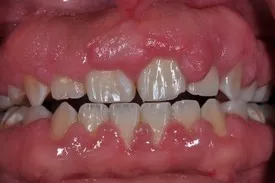 before crown lengthening - Las Vegas, NV