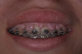 before crown lengthening - Las Vegas, NV