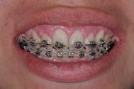after crown lengthening - Las Vegas, NV