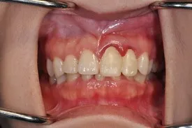 before crown lengthening - Las Vegas, NV