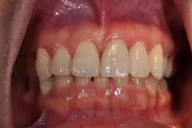 after crown lengthening - Las Vegas, NV