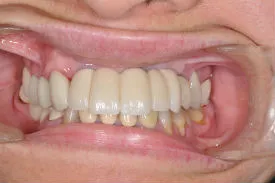 after full arch dental implants - Las Vegas, NV