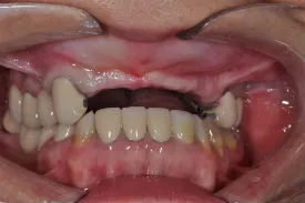 before full arch dental implants - Las Vegas, NV