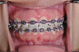 after dental braces - Las Vegas, NV