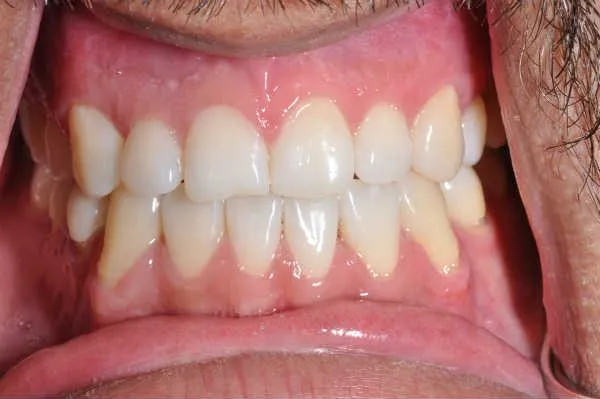 after gum recession treatment - Las Vegas, NV