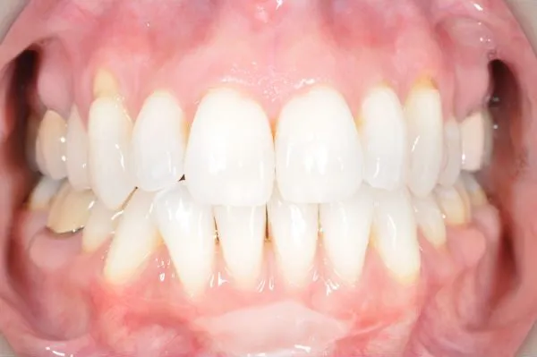 before pinhole surgery - Las Vegas, NV