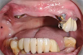 before full arch implants - Las Vegas, NV