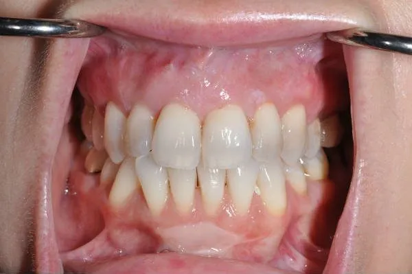 after pinhole surgery - Las Vegas, NV