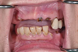 before full arch implants - Las Vegas, NV