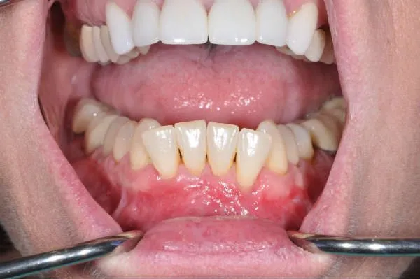 after pinhole surgery - Las Vegas, NV