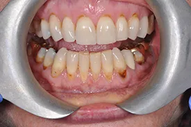 after surgical grafting - Las Vegas, NV