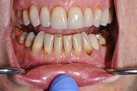 before surgical grafting - Las Vegas, NV