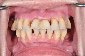 before surgical grafting - Las Vegas, NV