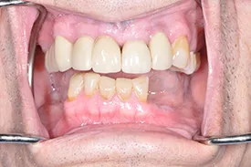 before full arch replacement - Las Vegas, NV