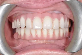 after full arch implants - Las Vegas, NV