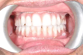after full arch implants - Las Vegas, NV