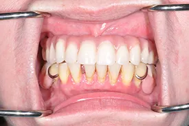 after surgical grafting - Las Vegas, NV