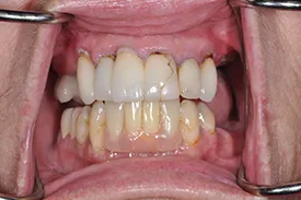 before full arch replacement - Las Vegas, NV