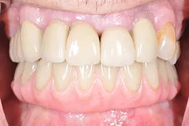 after full arch replacement - Las Vegas, NV