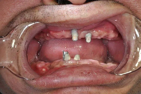 before full arch implants - Las Vegas, NV
