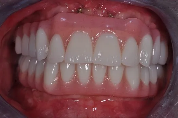 after full arch implants - Las Vegas, NV