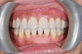 after gum graft - Las Vegas, NV