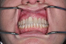after gum graft - Las Vegas, NV