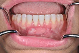 after gingival graft - Las Vegas, NV