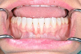 before gingival graft - Las Vegas, NV